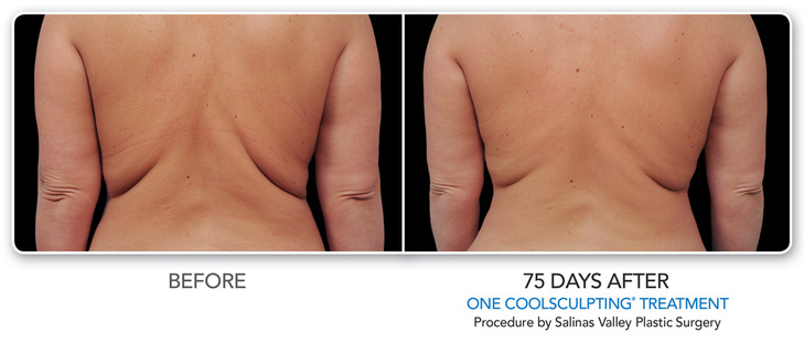 CoolSculpting Before and After 75